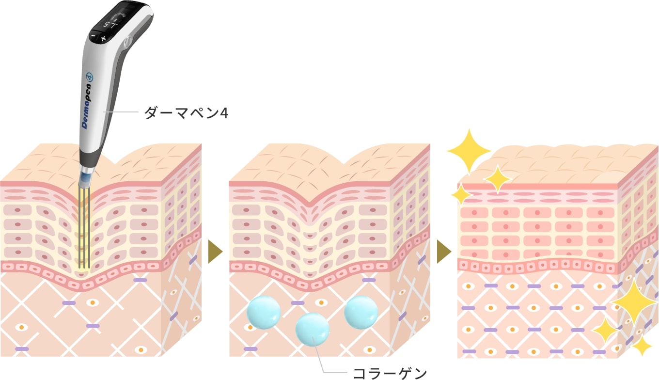 ダーマペン4