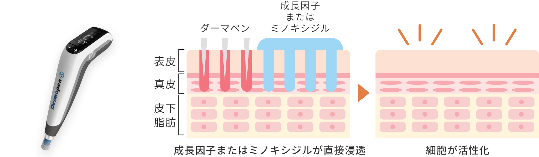 ダーマペン４育毛とは